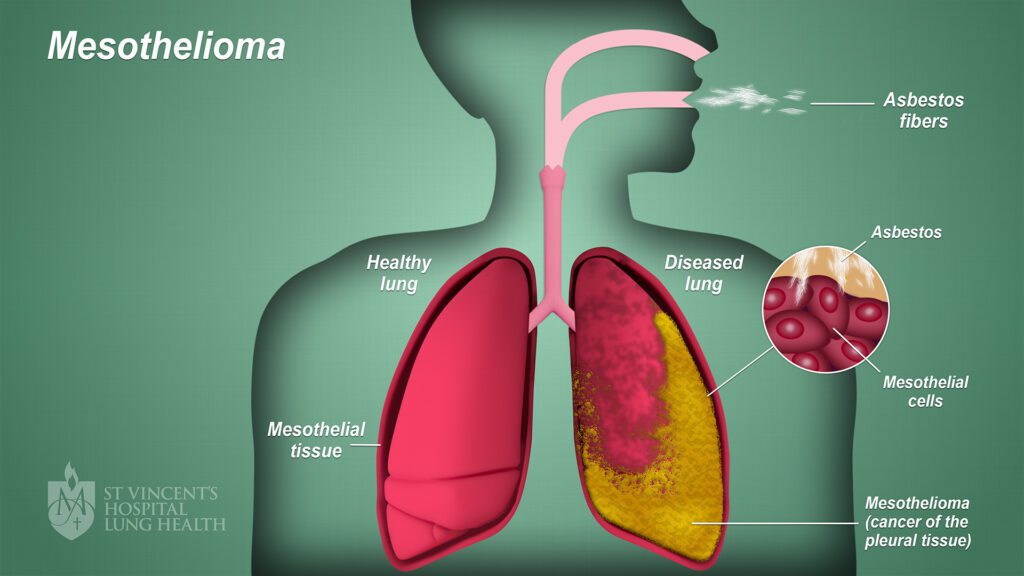 mesothelimia